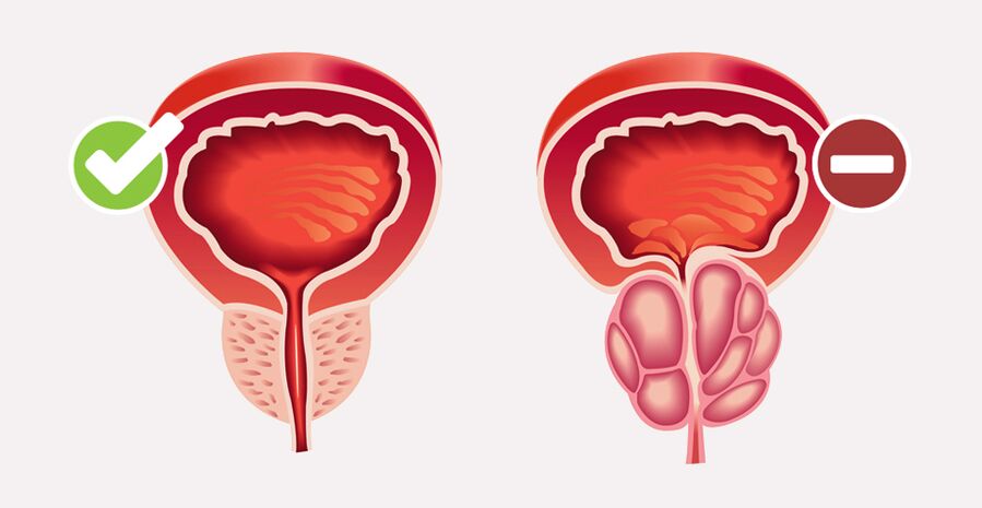 Weiprost normalizes the size and function of the prostate