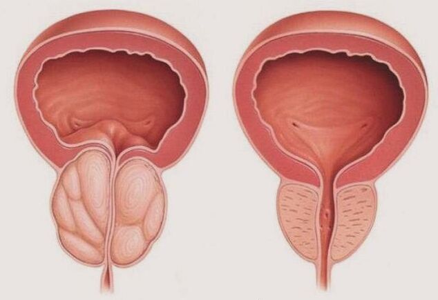 healthy and inflamed prostate with prostatitis