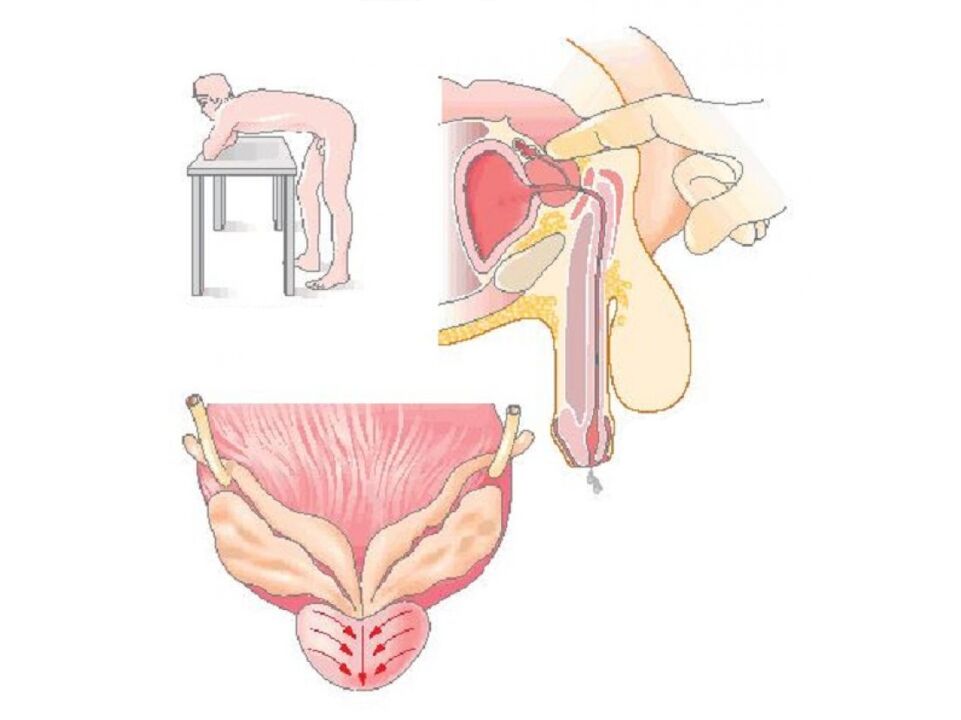 Prostate massage technique by a doctor to carry out an analysis of the secretion